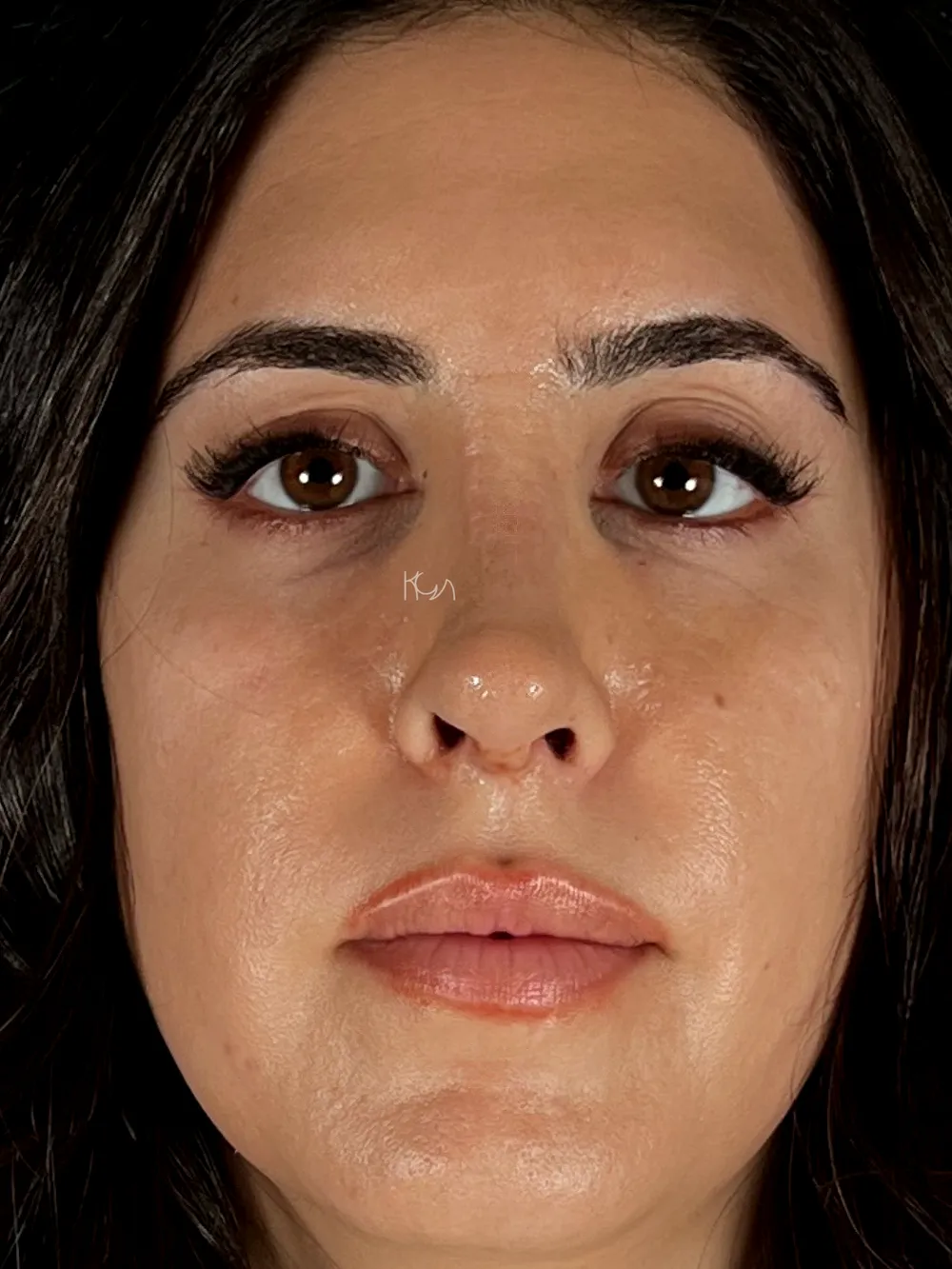 After: Revision rhinoplasty, Front