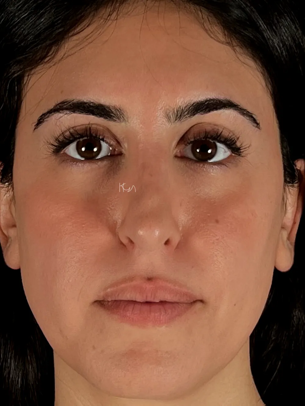 Before: Revision rhinoplasty, Front