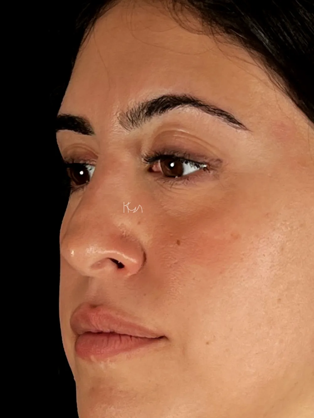 Before: Revision rhinoplasty, Three-quarter