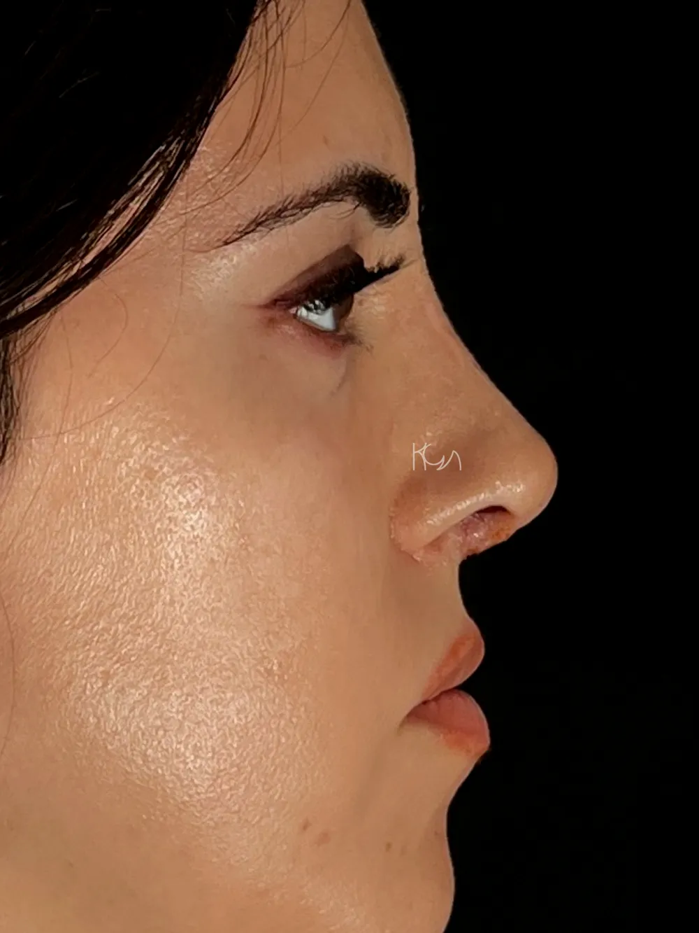After: Revision rhinoplasty, Profile