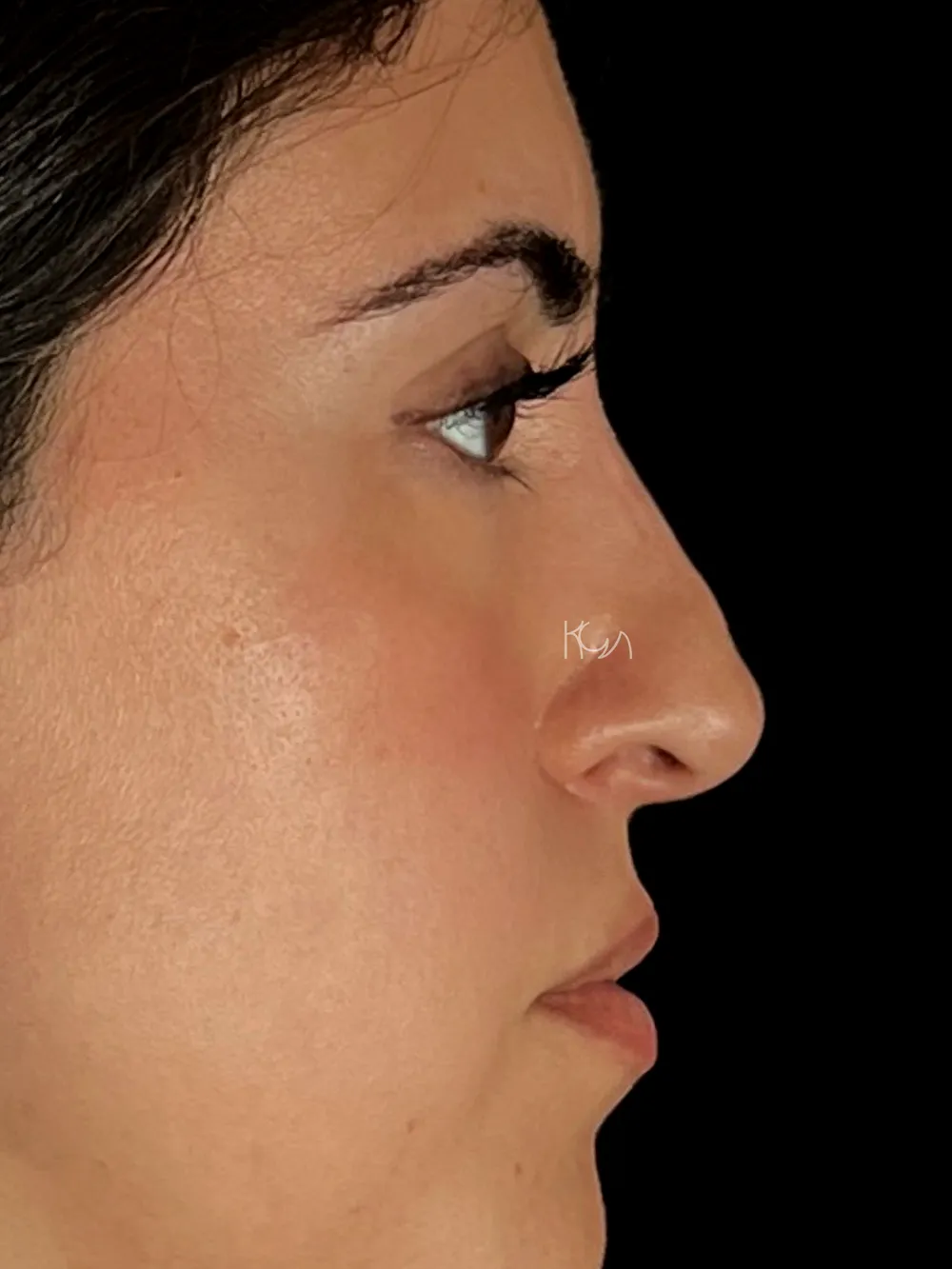 Before: Revision rhinoplasty, Profile