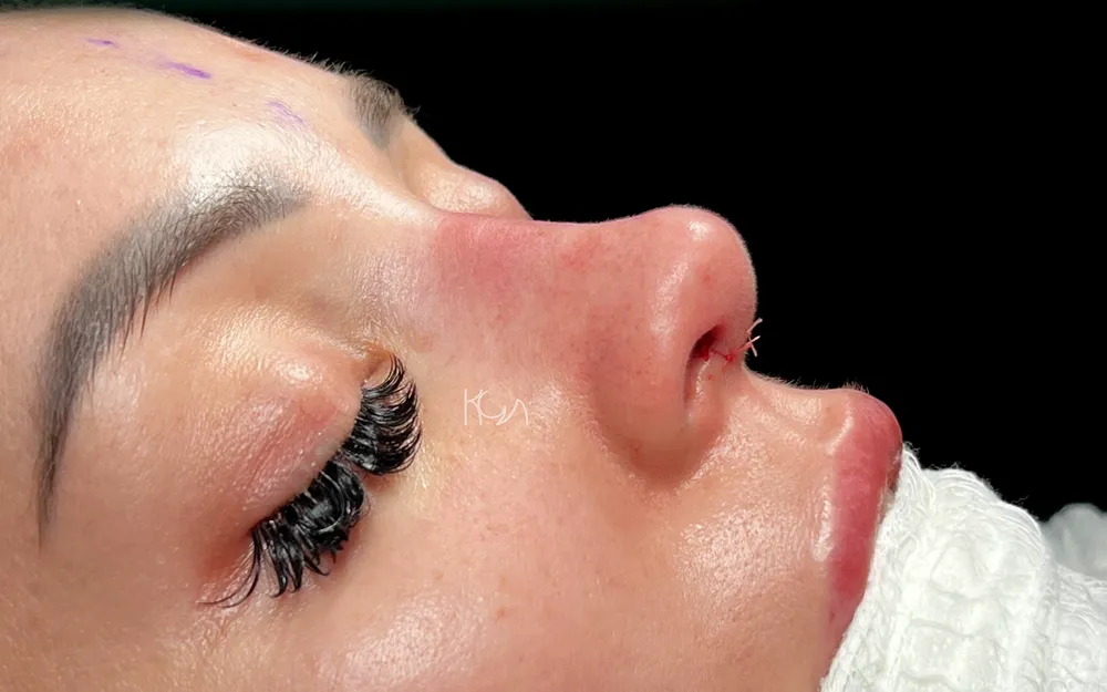 After: Primary rhinoplasty, Other three-quarter