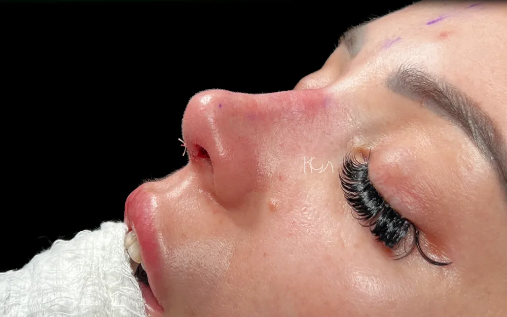 After: Primary rhinoplasty, Three-quarter