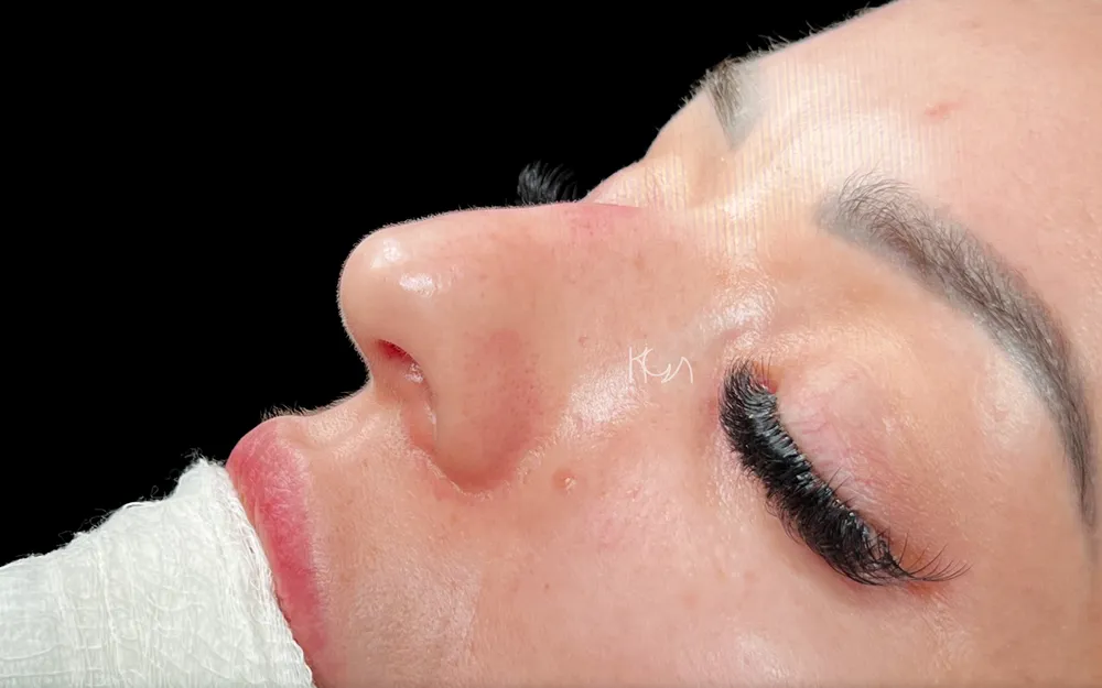 Before: Primary rhinoplasty, Three-quarter