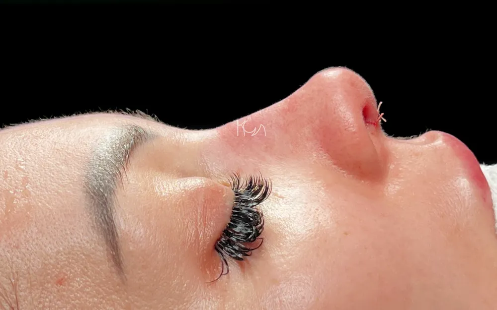 After: Primary rhinoplasty, Other profile