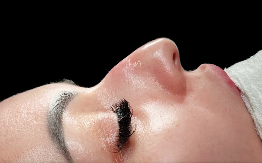 Before: Primary rhinoplasty, Other profile