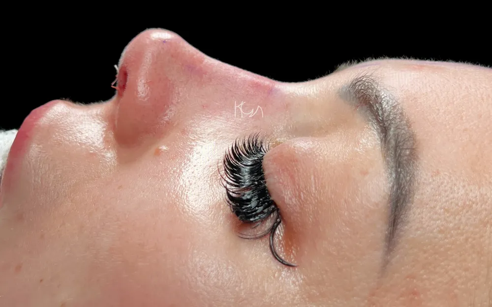 After: Primary rhinoplasty, Profile