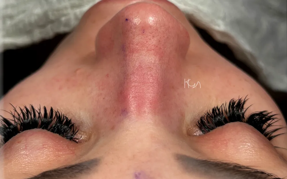 After: Rhinoplasty, Base
