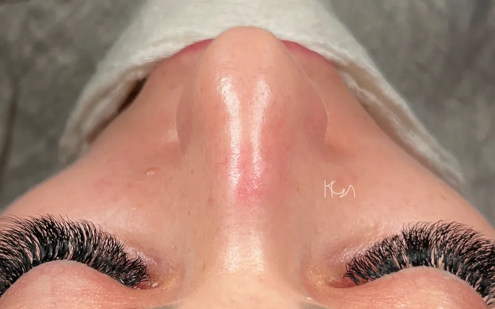 Before: Rhinoplasty, Base