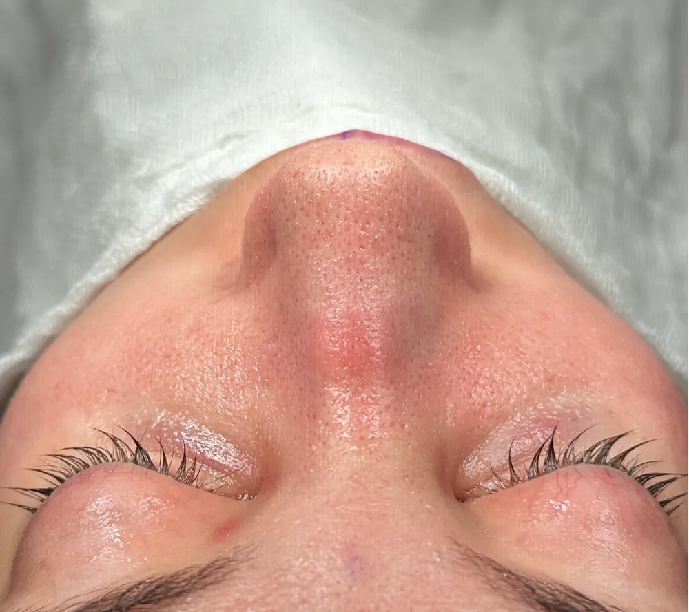 After: Primary rhinoplasty, Base