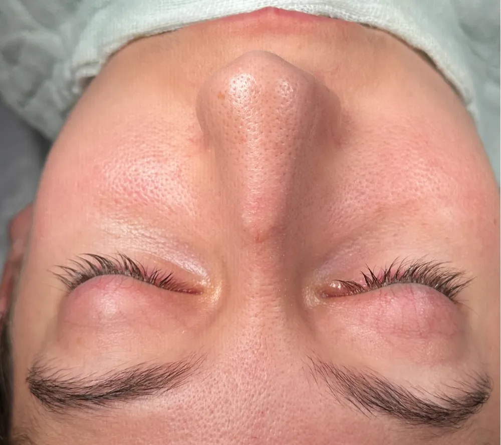 Before: Primary rhinoplasty, Base