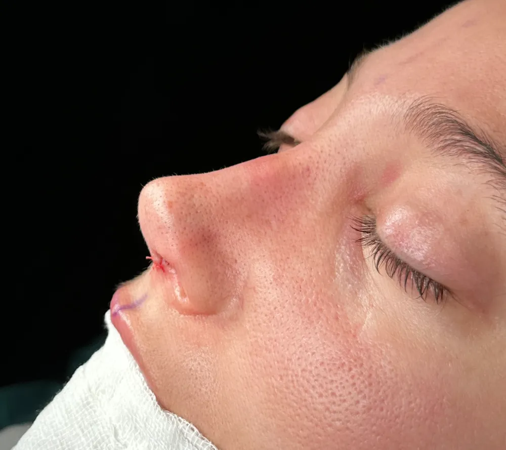 After: Primary rhinoplasty, Other three-quarter