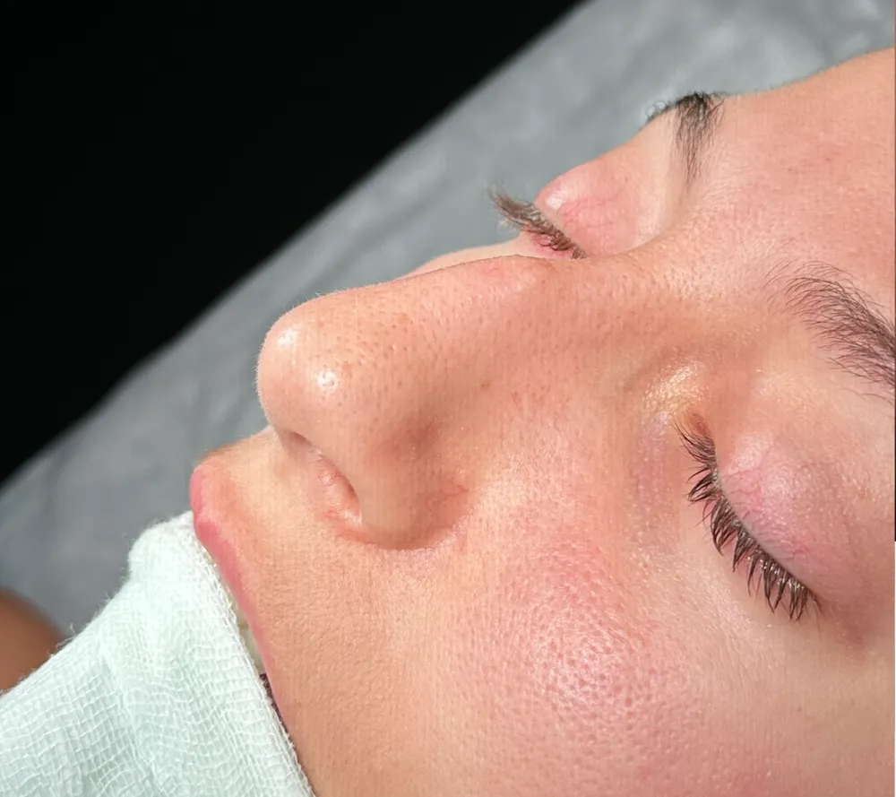 Before: Primary rhinoplasty, Other three-quarter
