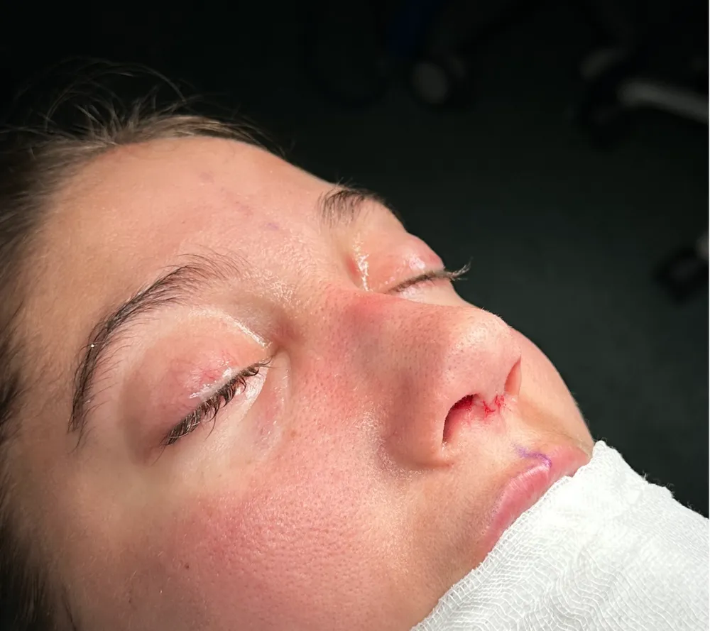 After: Primary rhinoplasty, Three-quarter