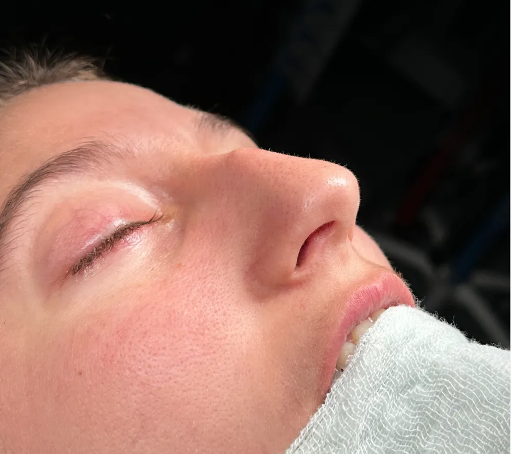 Before: Primary rhinoplasty, Three-quarter