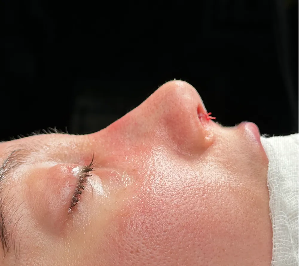 After: Primary rhinoplasty, Other profile