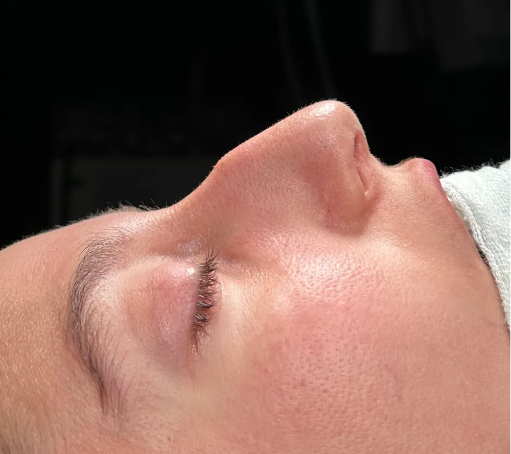 Before: Primary rhinoplasty, Other profile