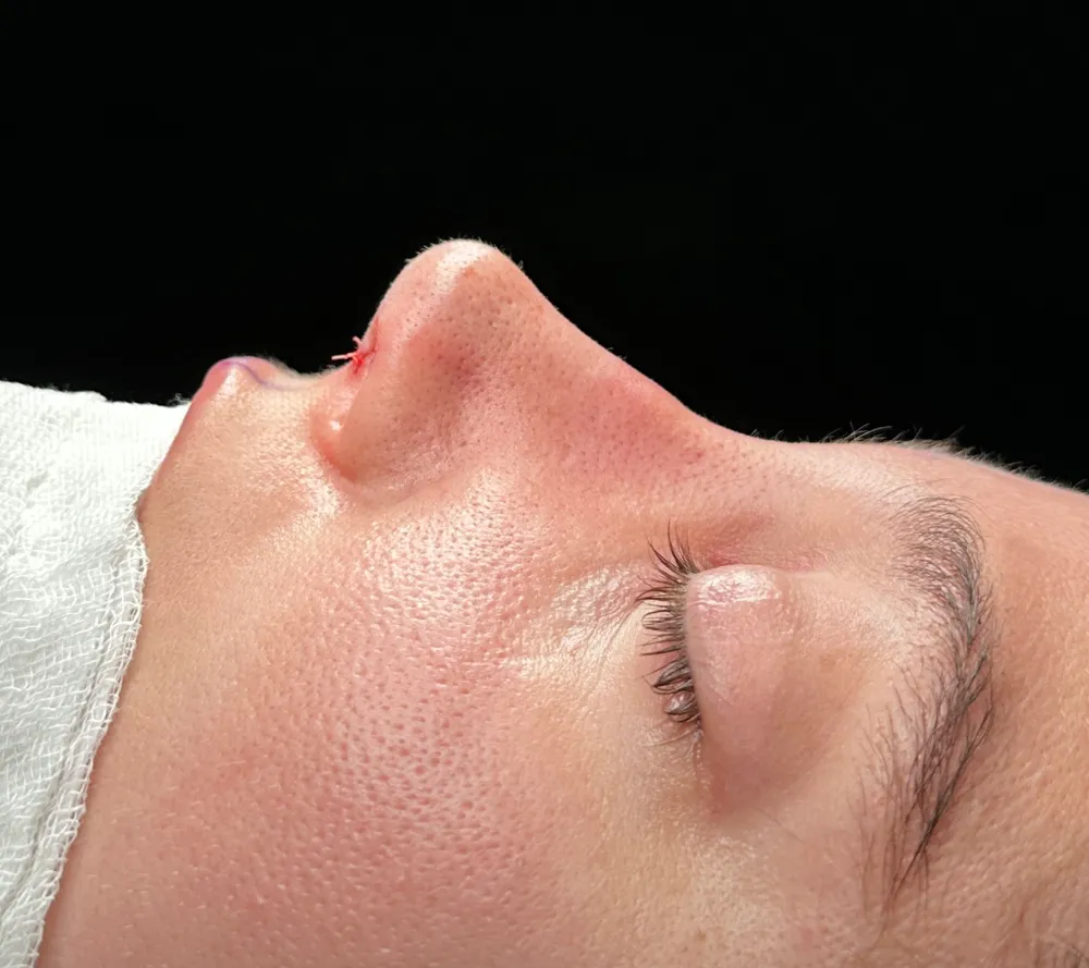 After: Primary rhinoplasty, Profile