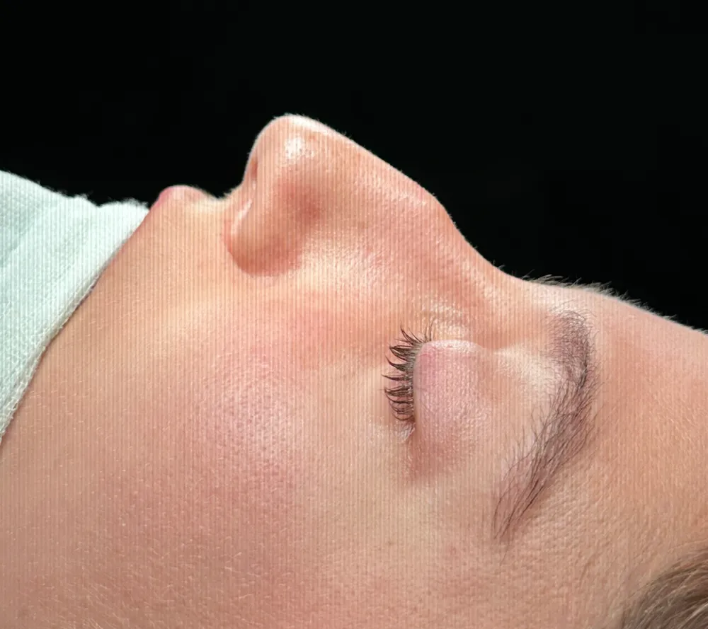 Before: Primary rhinoplasty, Profile