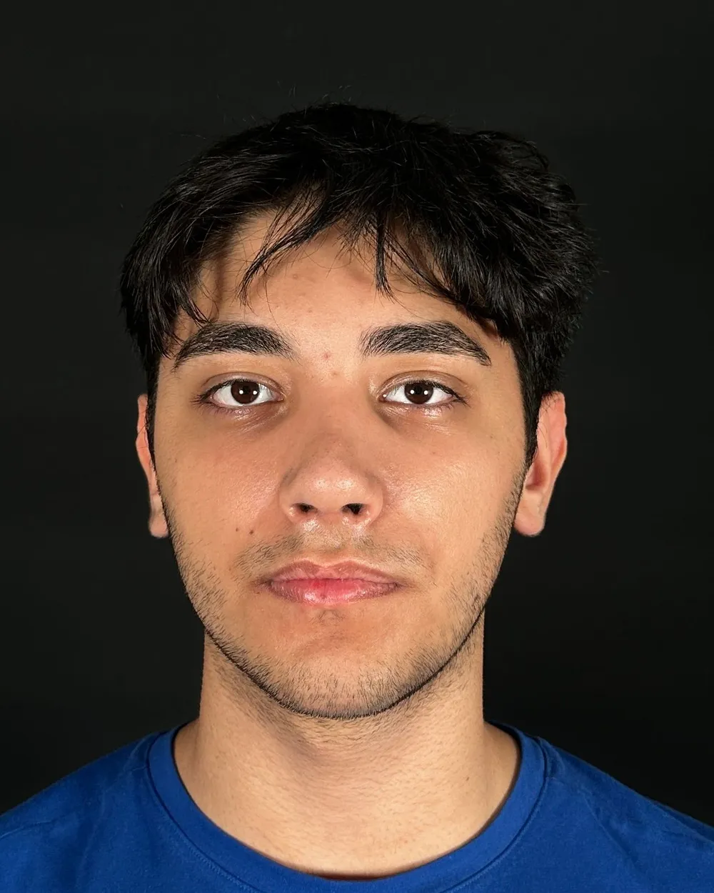 After: Primary rhinoplasty, Front