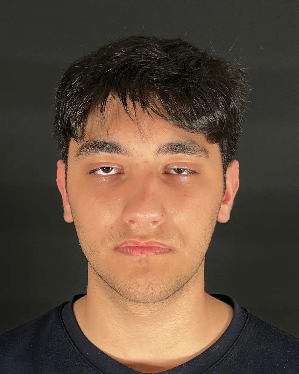 Before: Primary rhinoplasty, Front