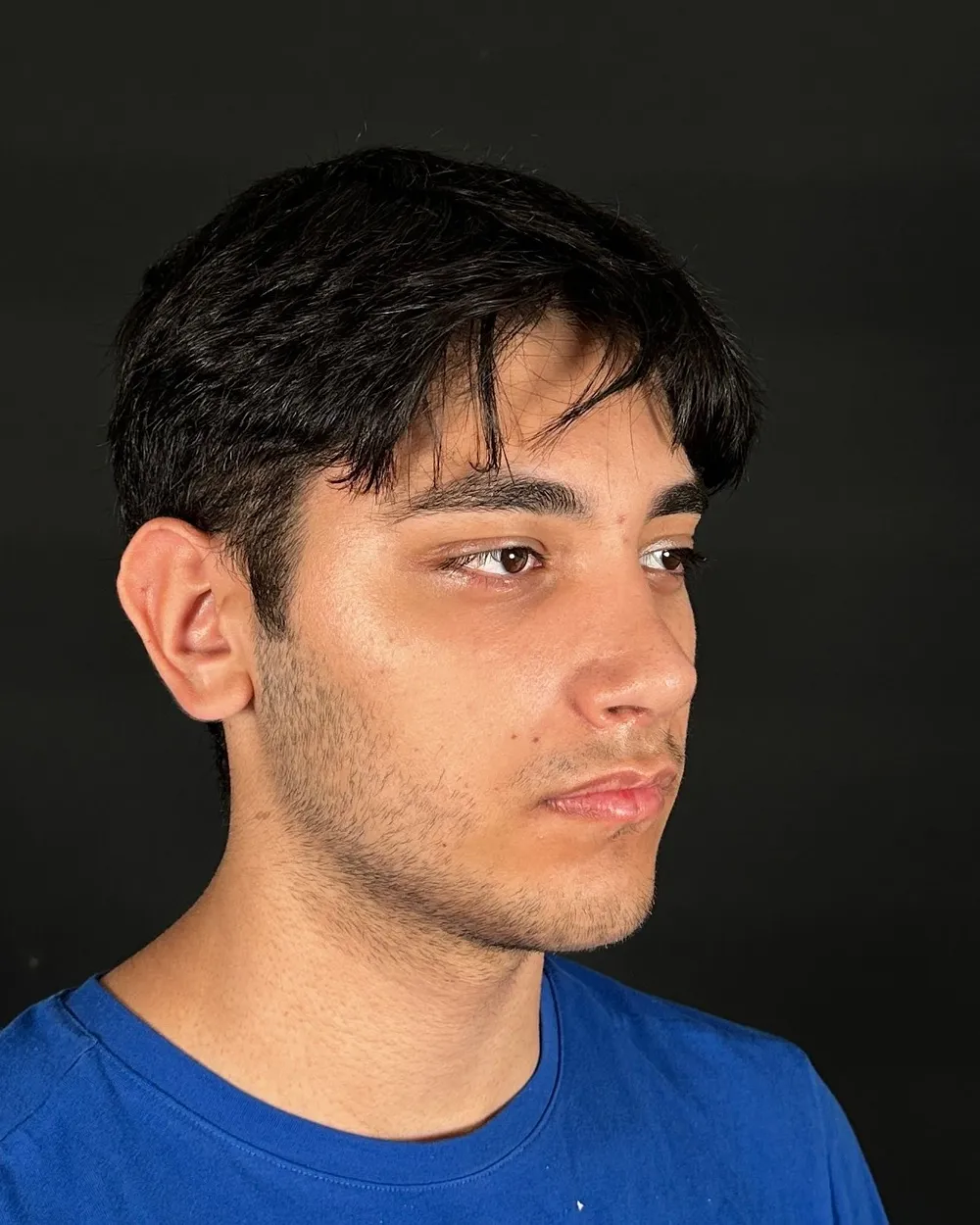 After: Primary rhinoplasty, Three-quarter