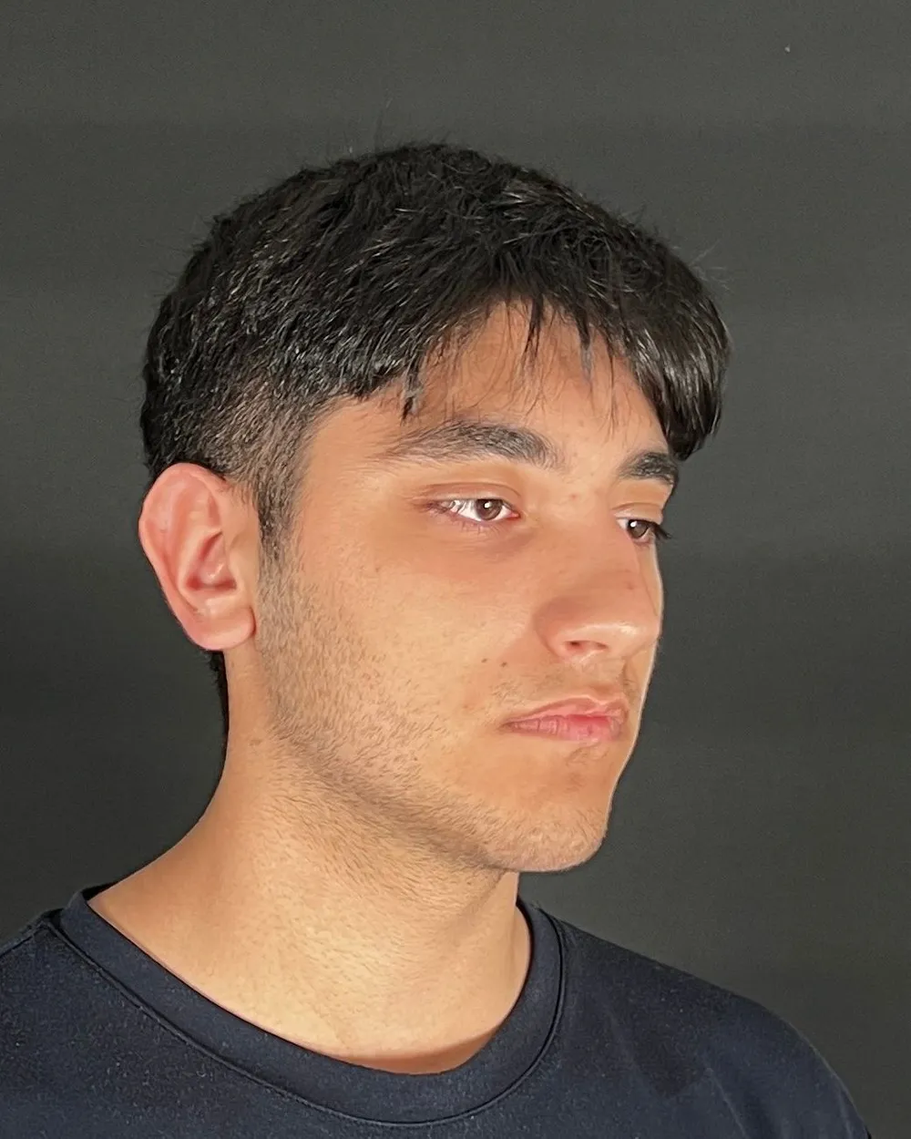 Before: Primary rhinoplasty, Three-quarter