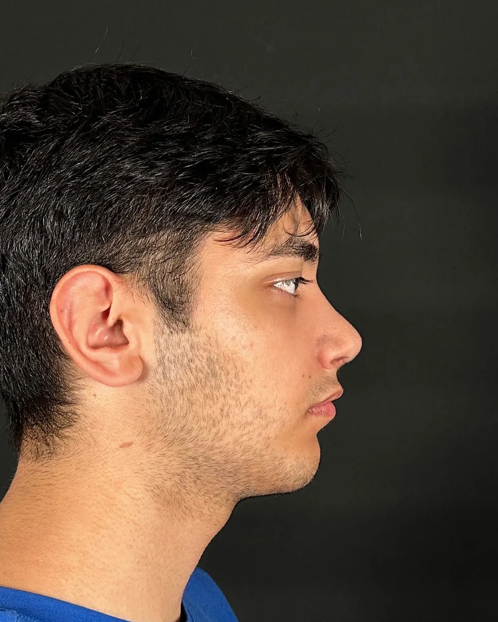 After: Primary rhinoplasty, Profile