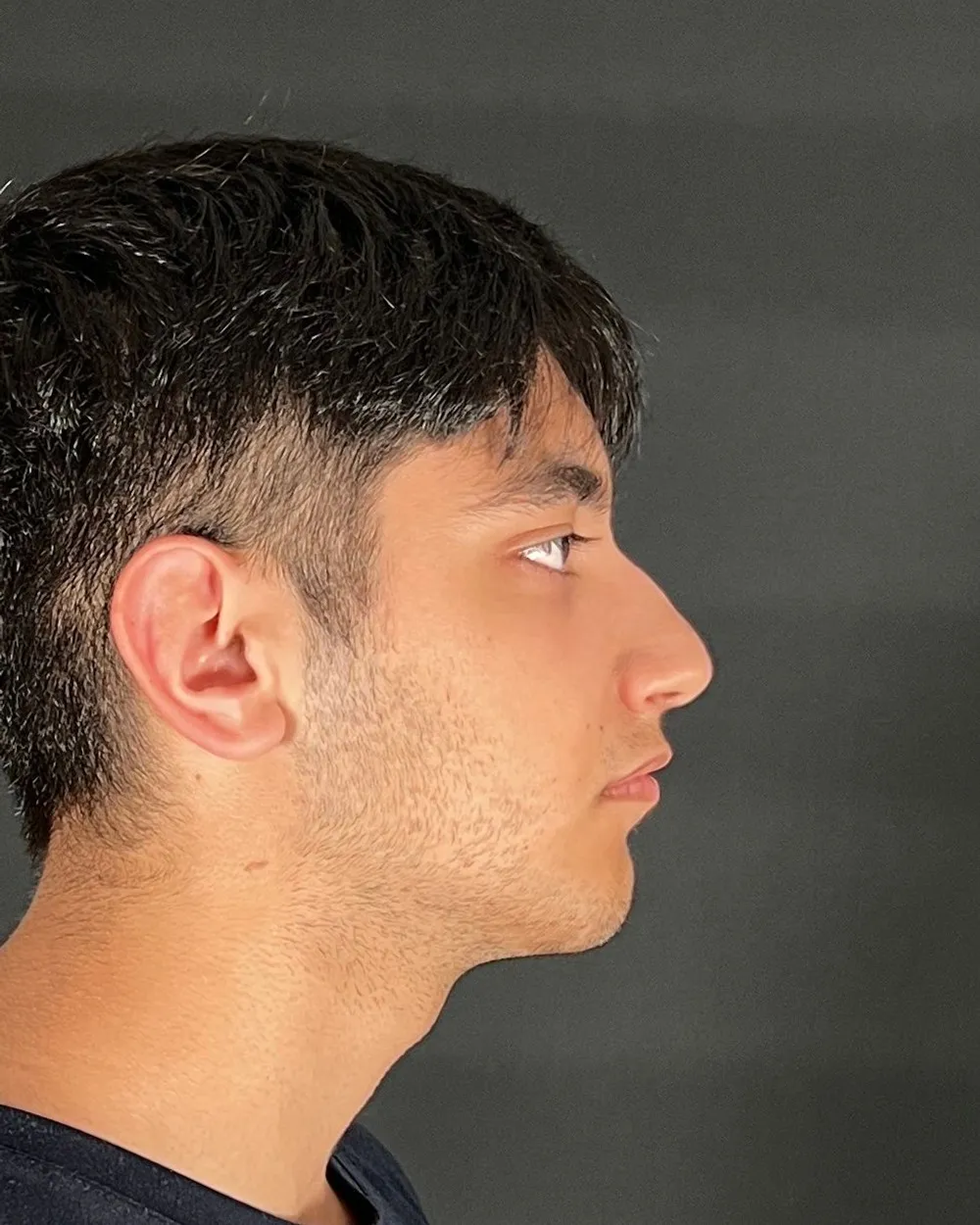Before: Primary rhinoplasty, Profile