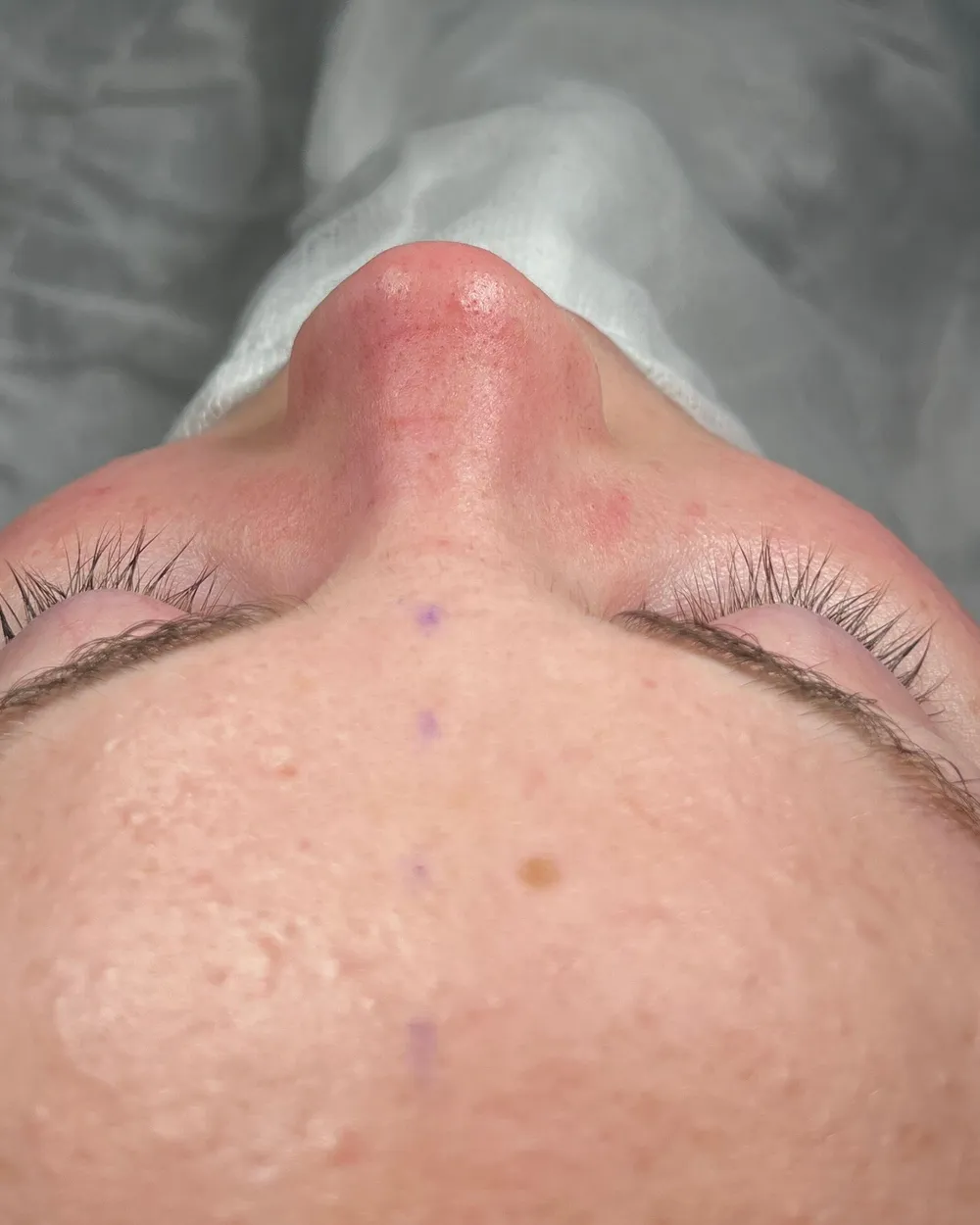 After: Primary rhinoplasty, Base
