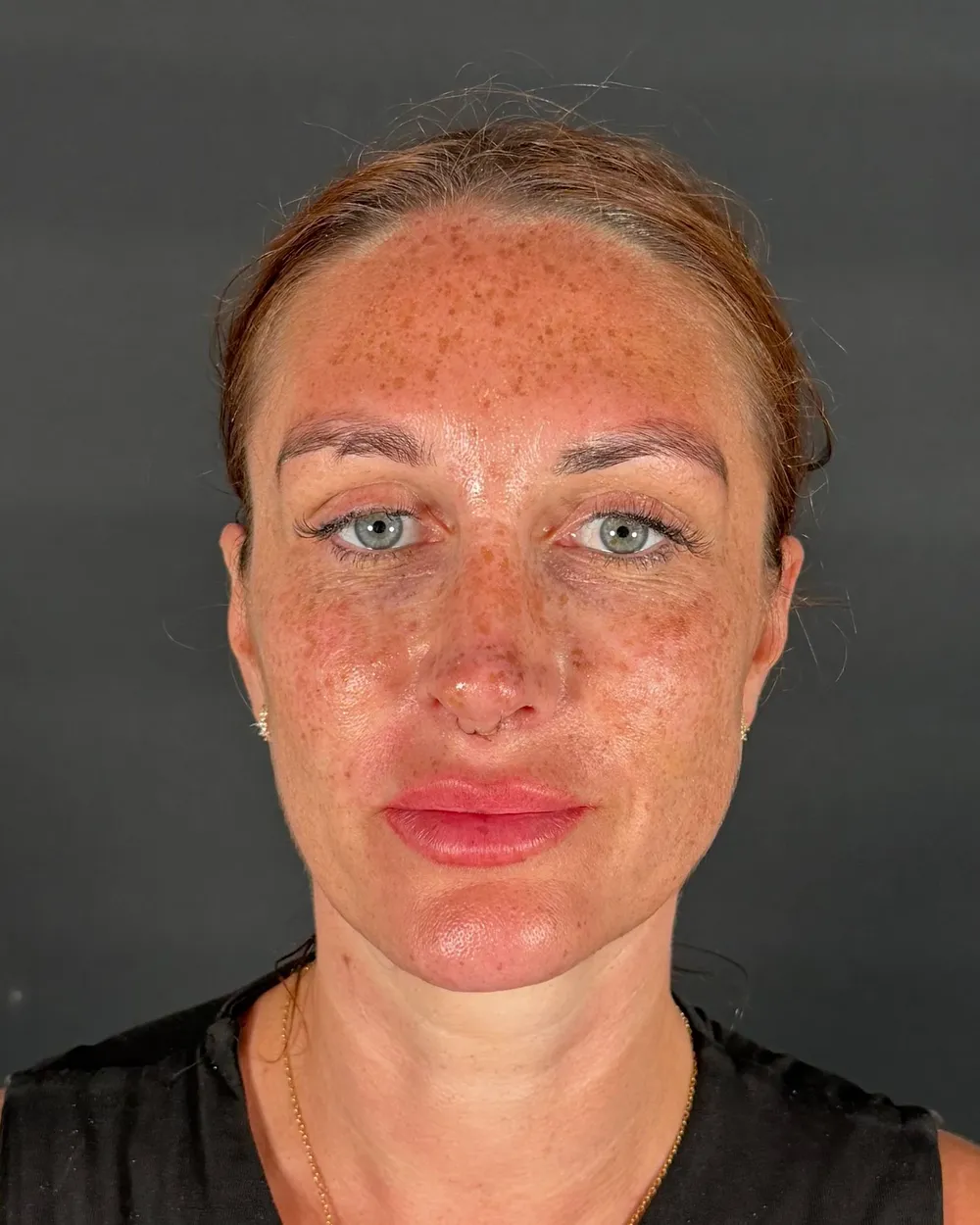 After: Revision rhinoplasty, Front