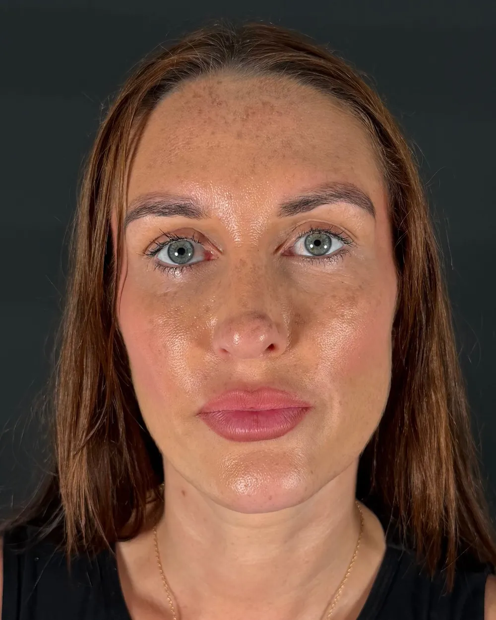 Before: Revision rhinoplasty, Front