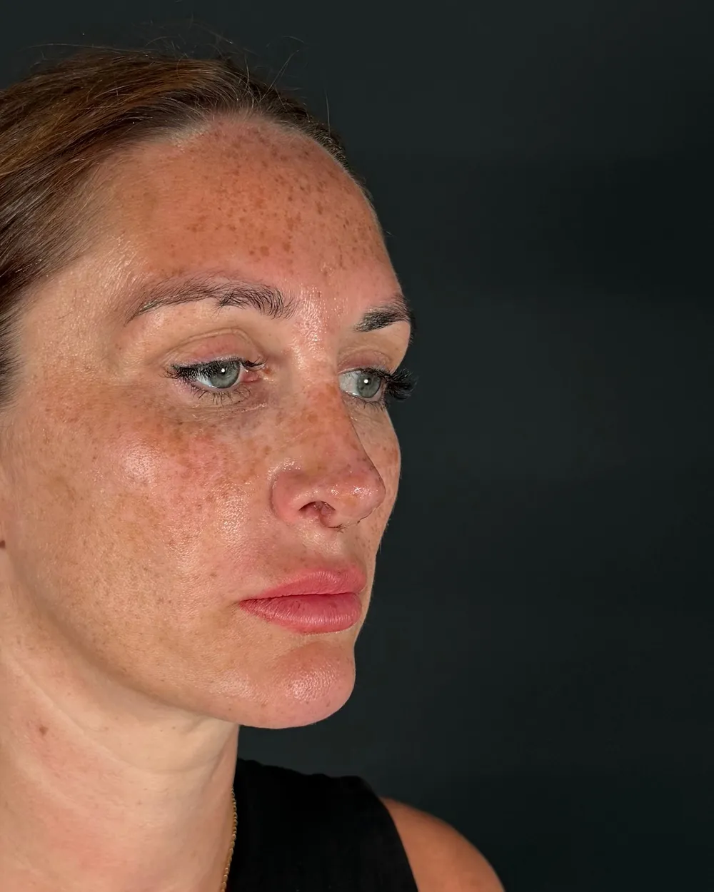 After: Revision rhinoplasty, Three-quarter