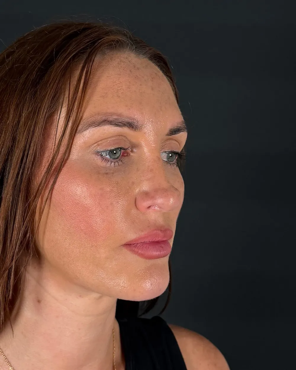Before: Revision rhinoplasty, Three-quarter