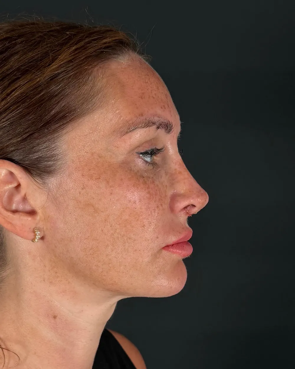 After: Revision rhinoplasty, Profile