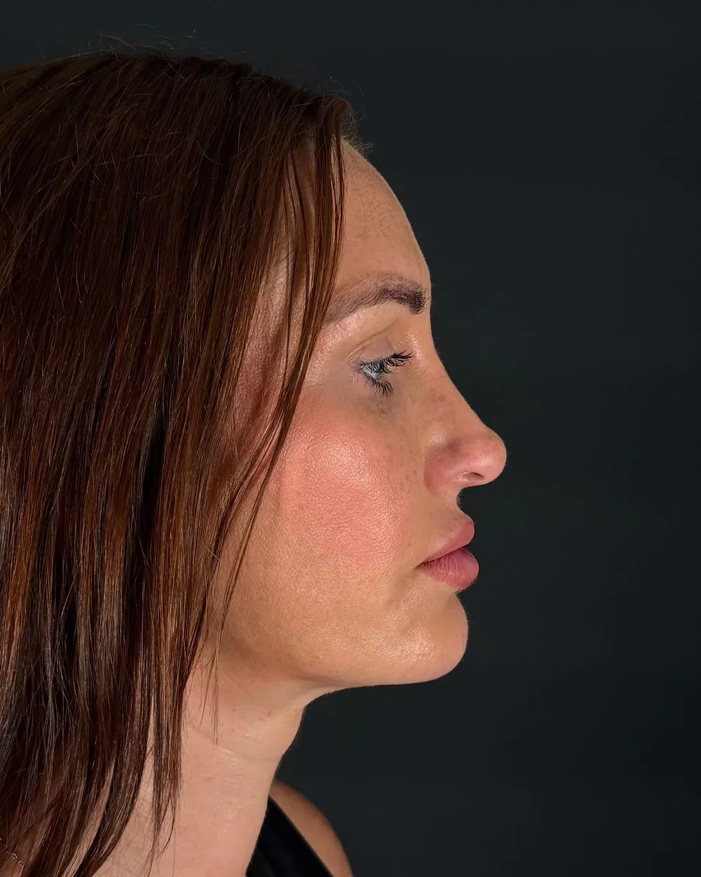 Before: Revision rhinoplasty, Profile