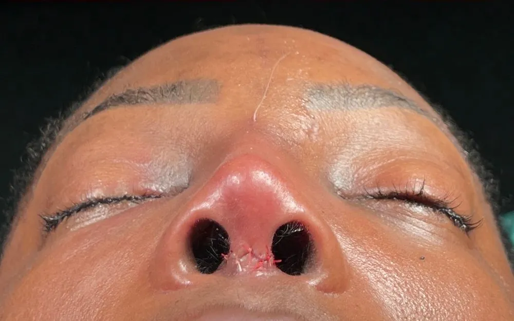After: Ethnic rhinoplasty, Base
