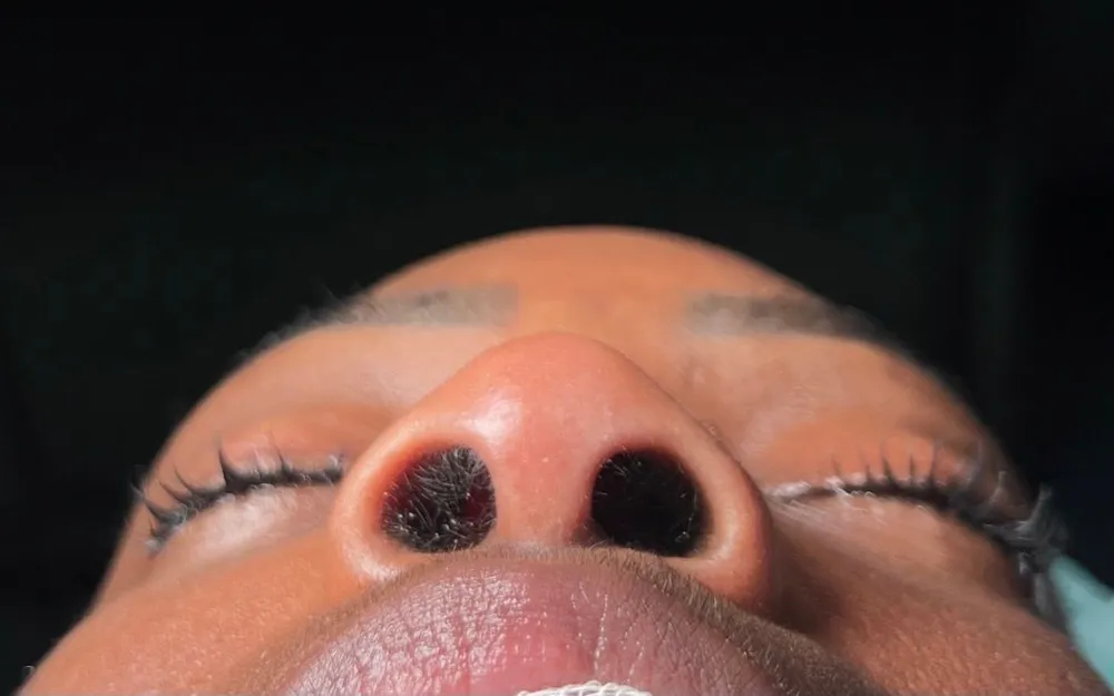 Before: Ethnic rhinoplasty, Base