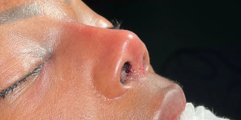 After: Ethnic rhinoplasty, Three-quarter