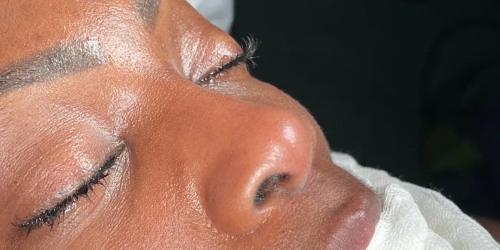 Before: Ethnic rhinoplasty, Three-quarter