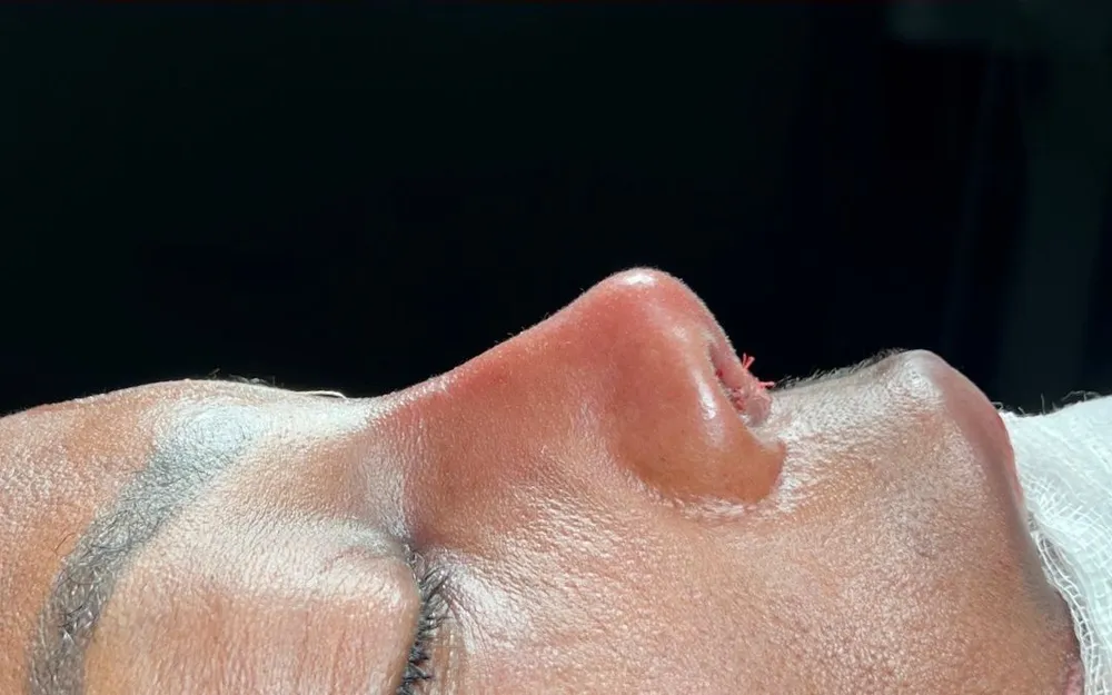 After: Ethnic rhinoplasty, Profile