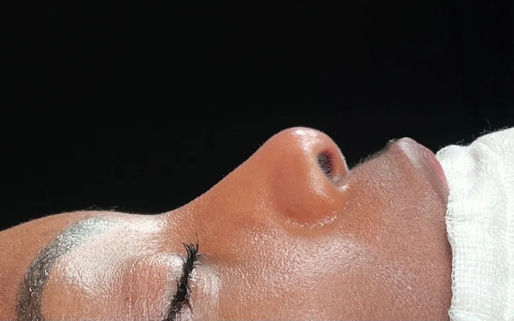 Before: Ethnic rhinoplasty, Profile